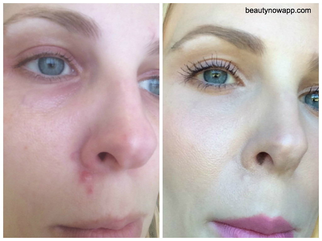 How To Cover Up A Flaky Pimple Beautynow Blog