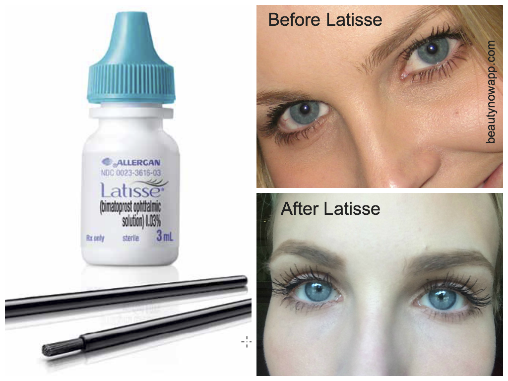 latisse-reviews-beautynow-blog